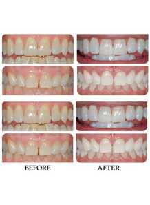 Carbamide Peroxide (Gel,...